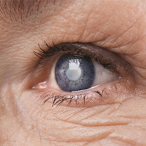 Cataract Close Up